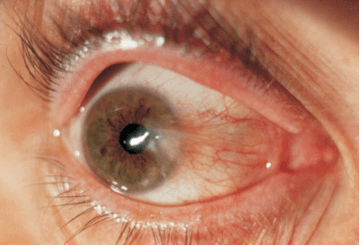Inflamacions Oculars
